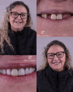 Lentes em Resina